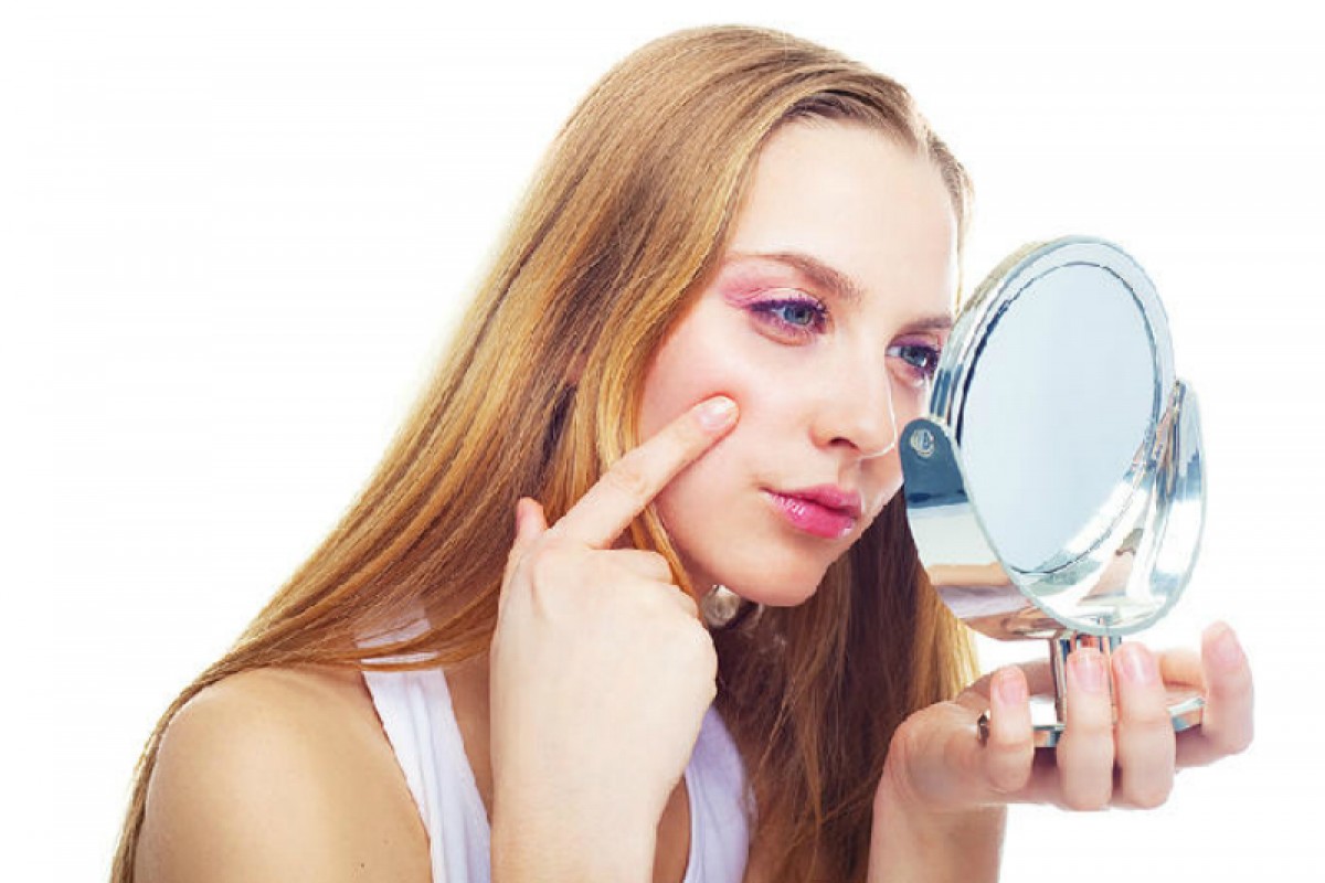 Per combattere l’acne meglio evitare latticini, zuccheri e grassi saturi