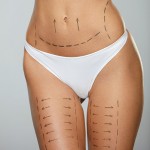 Surgical Lines On Beautiful Woman's Body. Closeup Of Female Slim Fit Body With Black Marks On Skin Before Plastic Surgery Operation. Girl In Perfect Sexy Body Shape In White Underwear. High Resolution