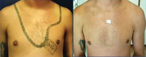 Tatuaggio prima e dopo 8 sedute