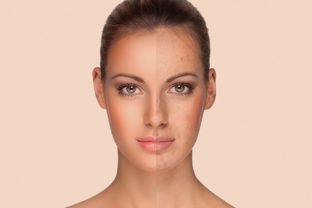 (Italiano) PLASMAONE La radiofrequenza innovativa per acne, rughe e smagliature