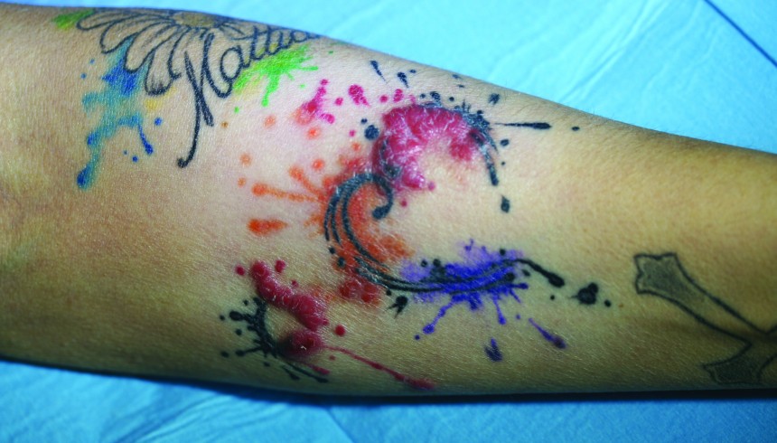 tatuaggio allergia