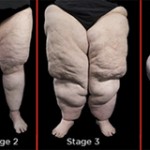 lipo
