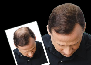 impiantocapelli1