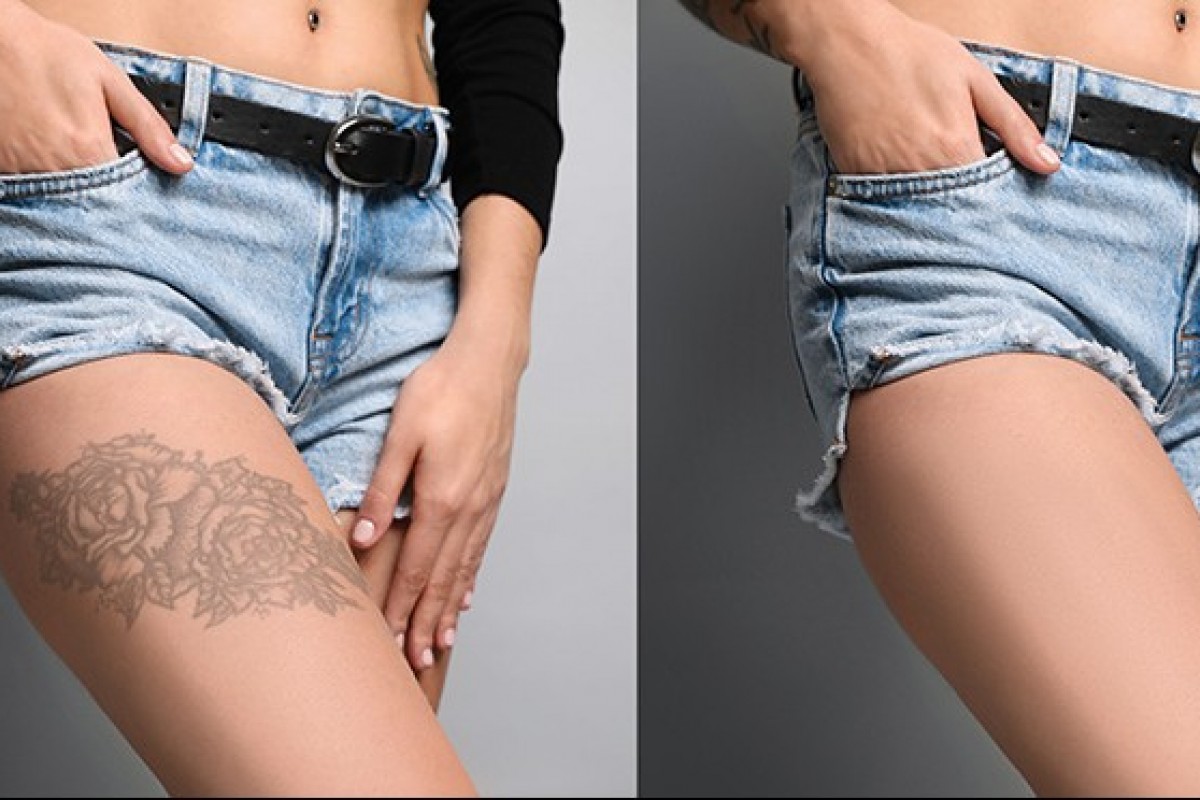 Eterna bellezza:Hollywood Spectra per la rimozione  dei tatuaggi